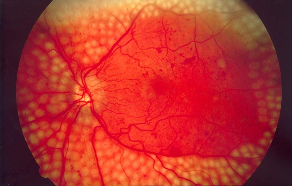 Diabetic retinopathy. Mildronate. Retinalamin